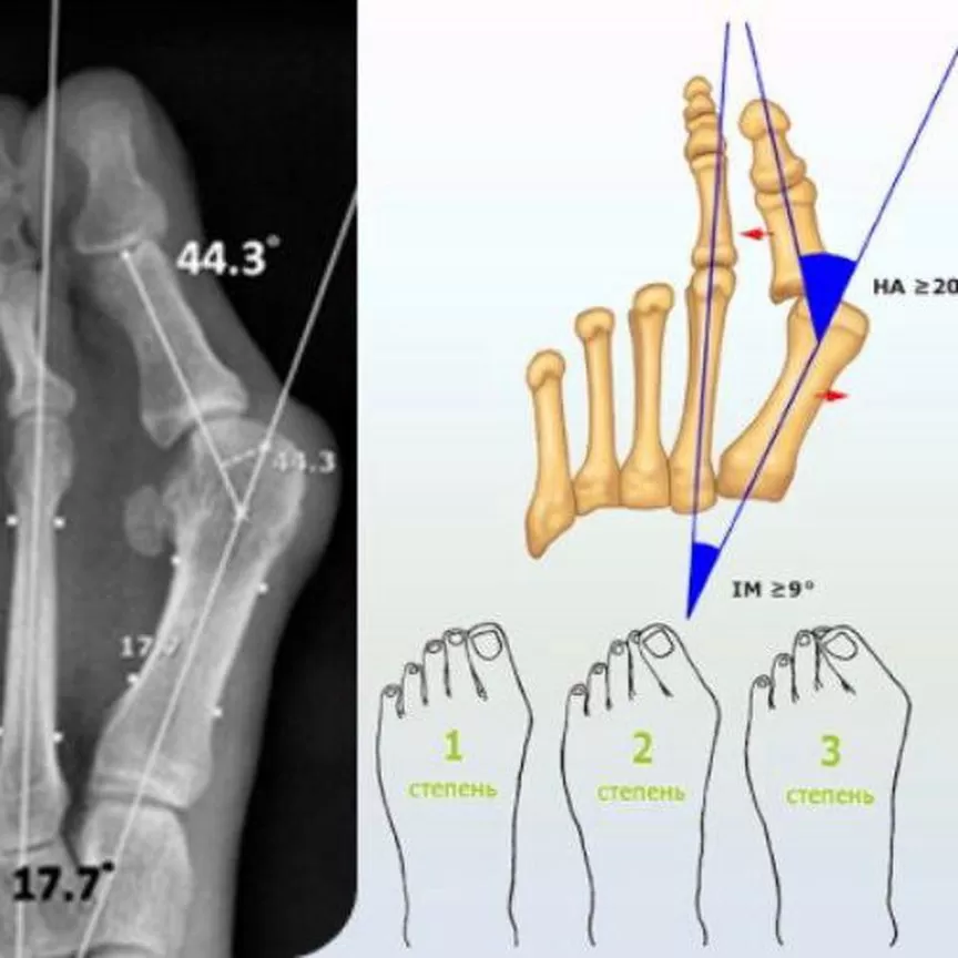 Мкб 10 плюсневая кость. Халюс вальгус степени на рентгене. Вальгусная деформация фаланги первого пальца. Хальгус вальгусрениген. Степень деформации халюкс вальгус.